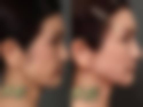 曲阜医联美雅致整形医院怎么样求美者反馈