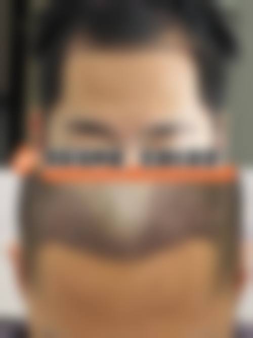 苏州新生植发怎么样医生团队实力