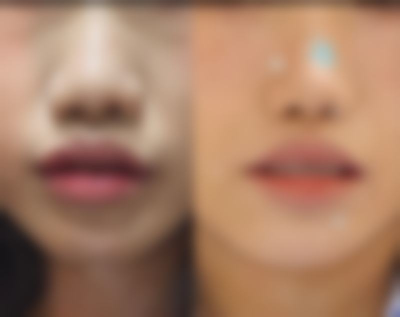 王淑珍医生的特色技术——术前对比方案选择