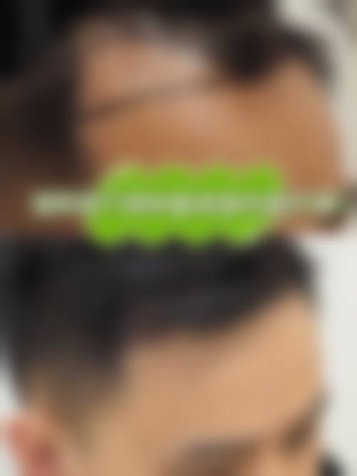 济南大麦微针植发怎么样基本信息