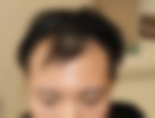 济南大麦微针植发怎么样特色项目及技术优势