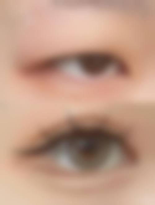 邵尉医生的眼部整形:定制专属美眼