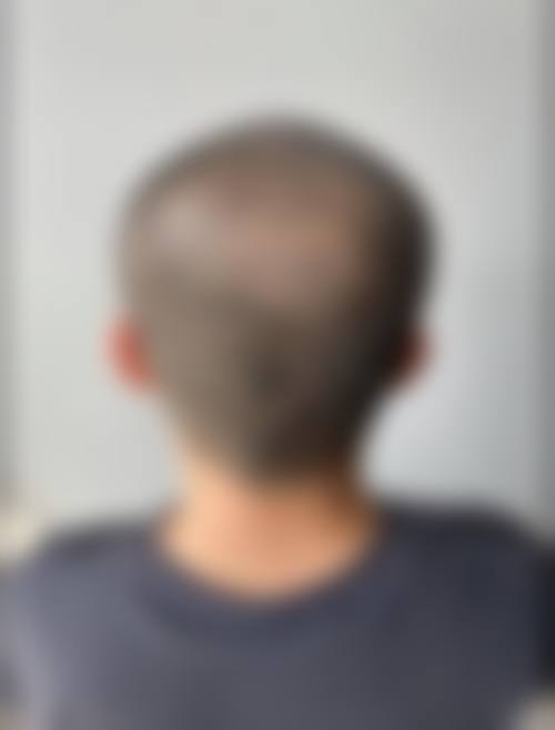 方建文医生可开展的全品类植发诊疗项目