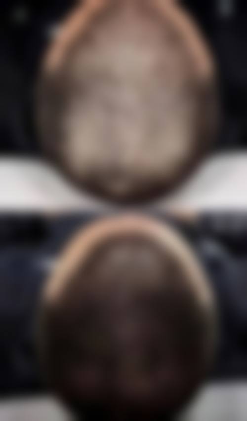 淮安高第植发求美者反馈