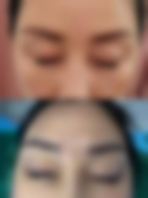 佛山大麦微针植发医生团队实力