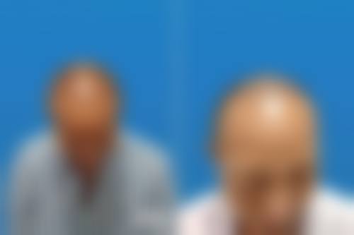 佛山大麦微针植发特色项目及技术优势