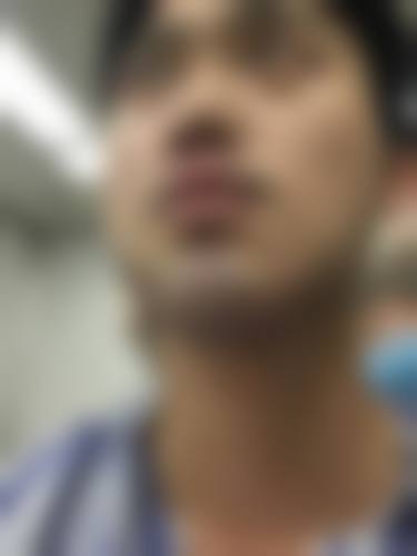 佛山大麦微针植发简介概述