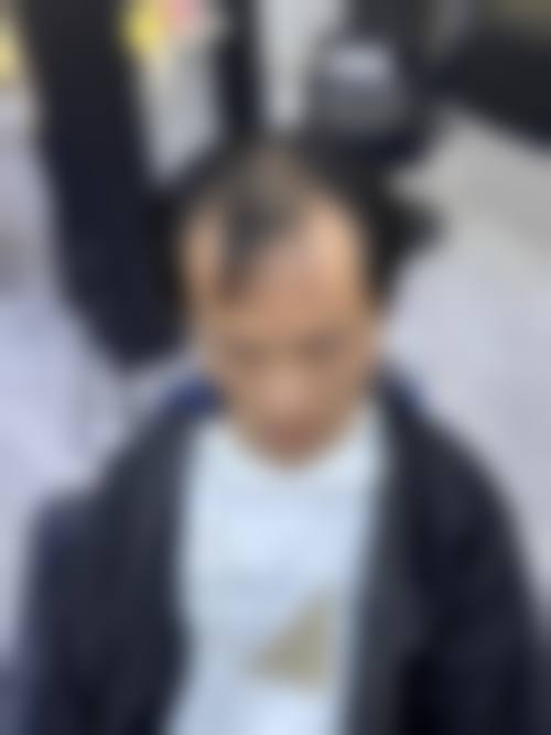 重庆渝北新沐植发医院价格收费