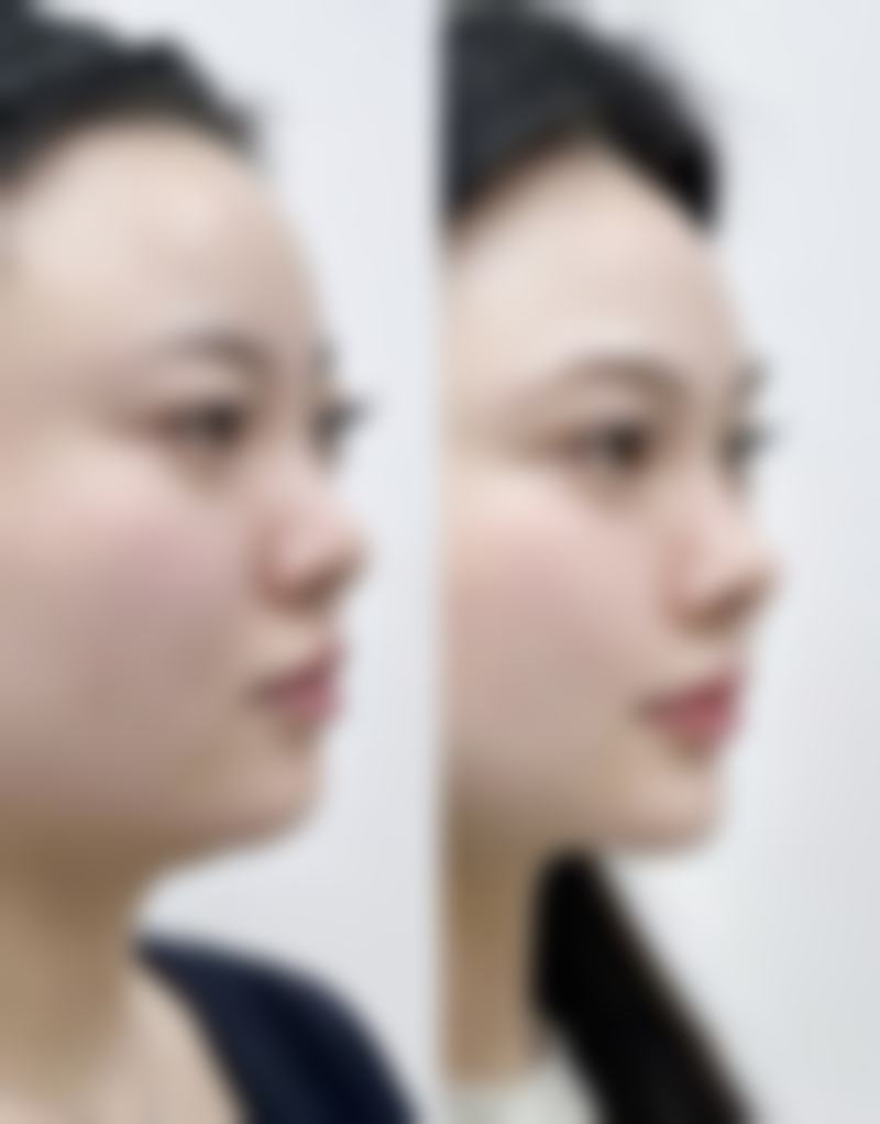 泰国咖蒙KAMOL整形美容医院求美者反馈