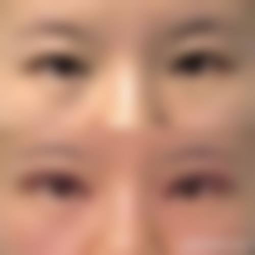 马红婕医师特色项目:高认可度的下颌角磨骨与隆胸手术