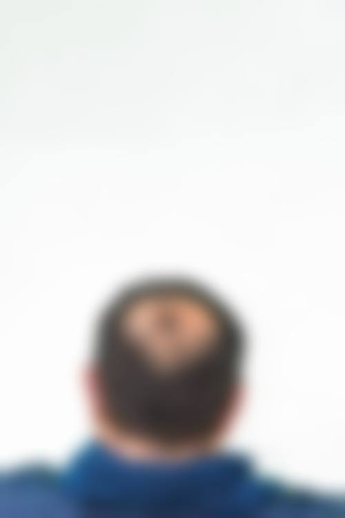为什么要选择温州伊美尔加禾植发连锁机构?